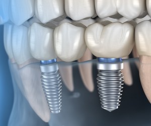 Dental bridge and dental implants in Hammonton, NJ